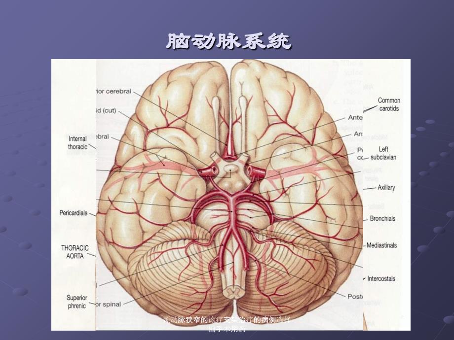 颈动脉狭窄的诊疗支架治疗的病例选择围手术用药培训课件_第2页