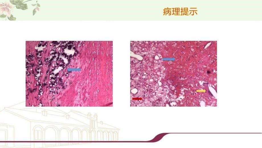 易损斑块的诊断与鉴别诊断_第5页