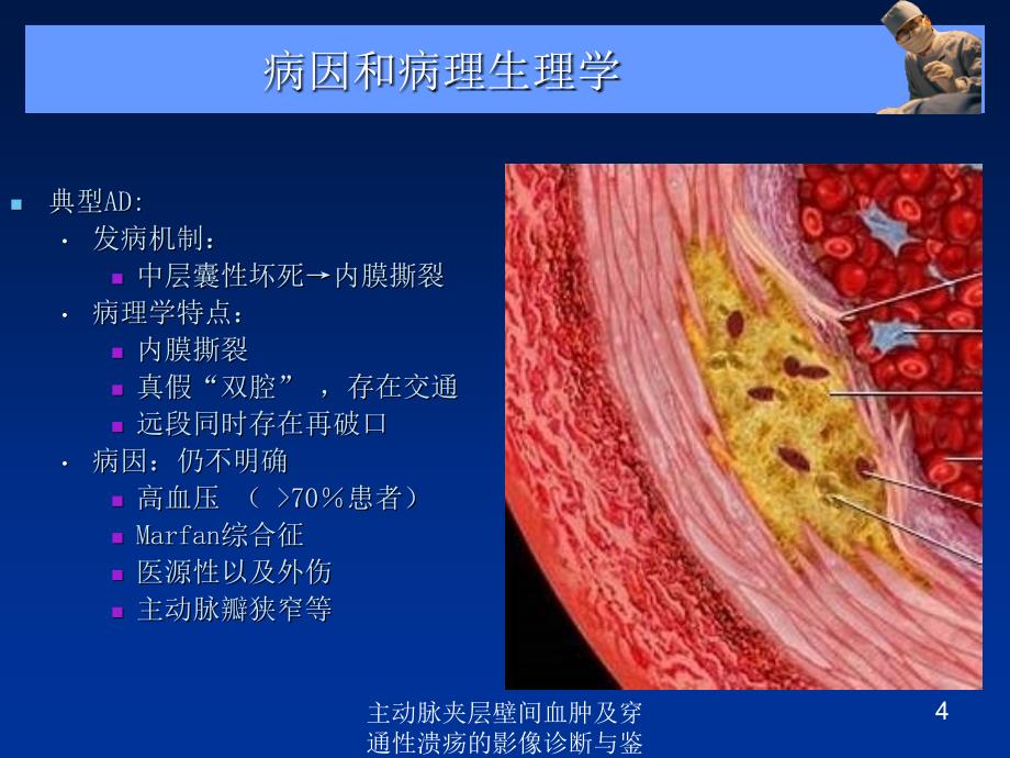 主动脉夹层壁间血肿及穿通性溃疡的影像诊断与鉴别诊断培训课件_第4页